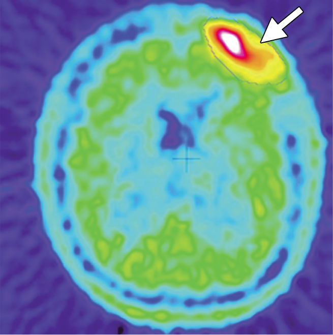 Residual tumor after near-total resection in a patient with meningioma
